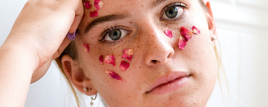 rosacea